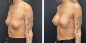 before and after breast augmentation female patient left angled view case 2018