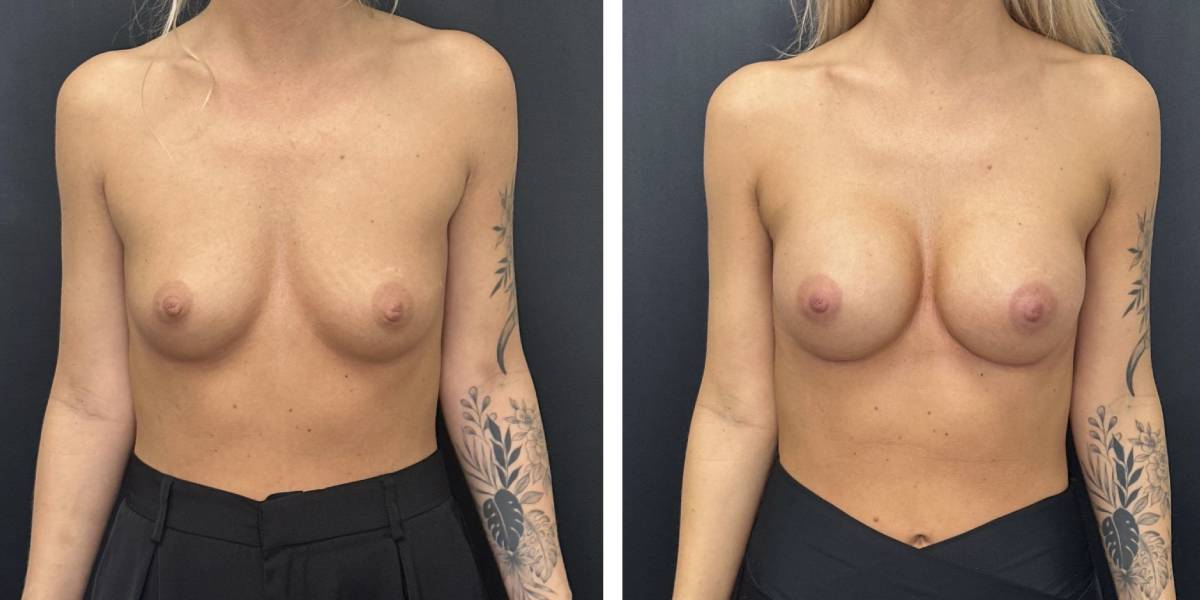 before and after breast augmentation female patient front view case 2018