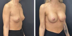 before and after breast augmentation female patient right angled view case 2018