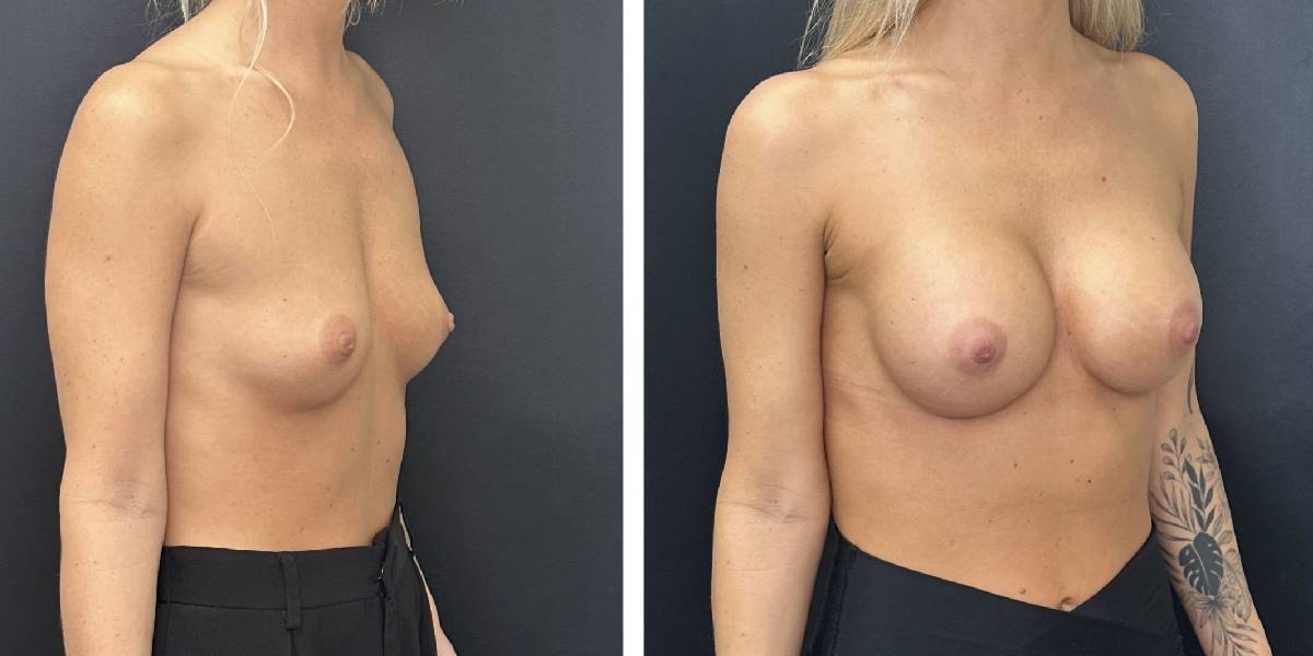 before and after breast augmentation female patient right angled view case 2018