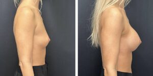 before and after breast augmentation female patient right side view case 2018