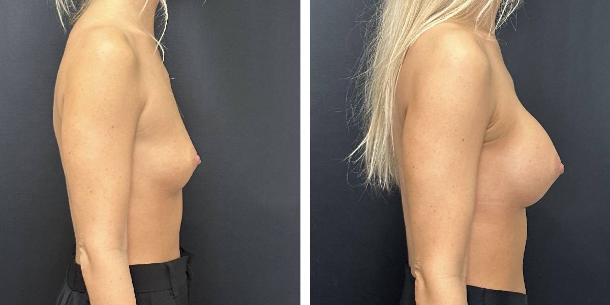 before and after breast augmentation female patient right side view case 2018