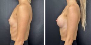 before and after breast augmentation female patient left side view case 2025
