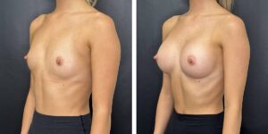 before and after breast augmentation female patient left angled view case 2025