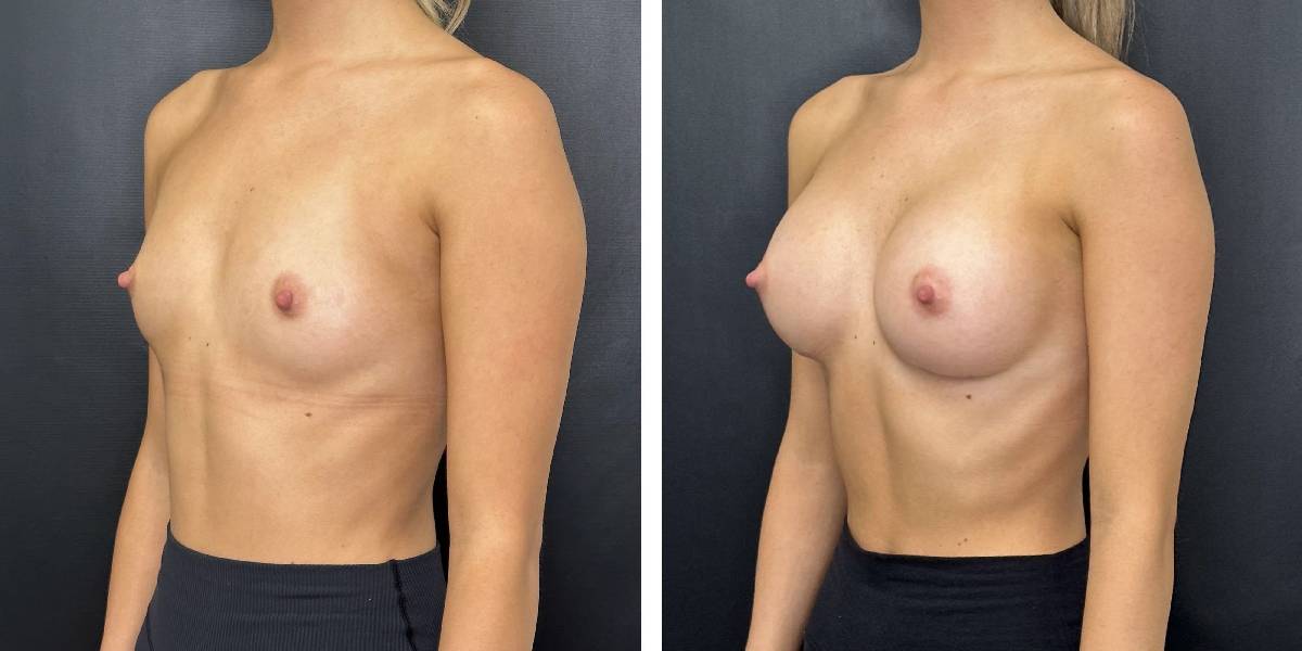 before and after breast augmentation female patient left angled view case 2025