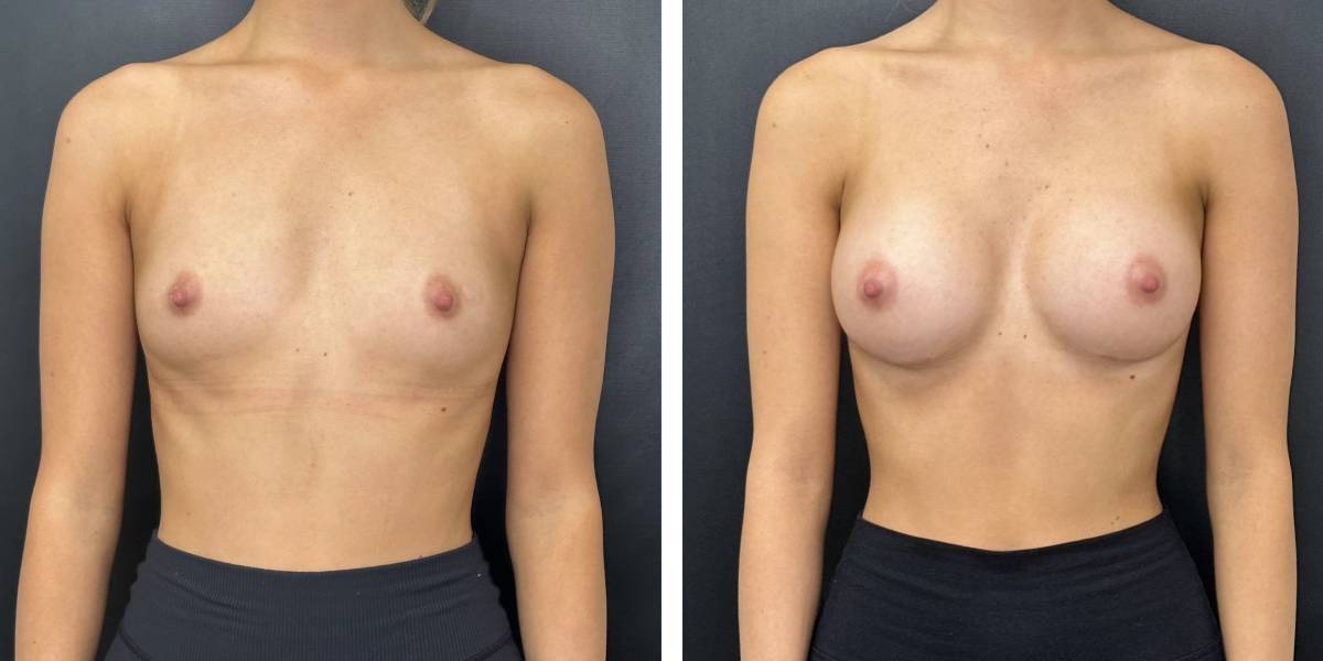 before and after breast augmentation female patient front view case 2025