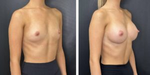 before and after breast augmentation female patient right angled view case 2025