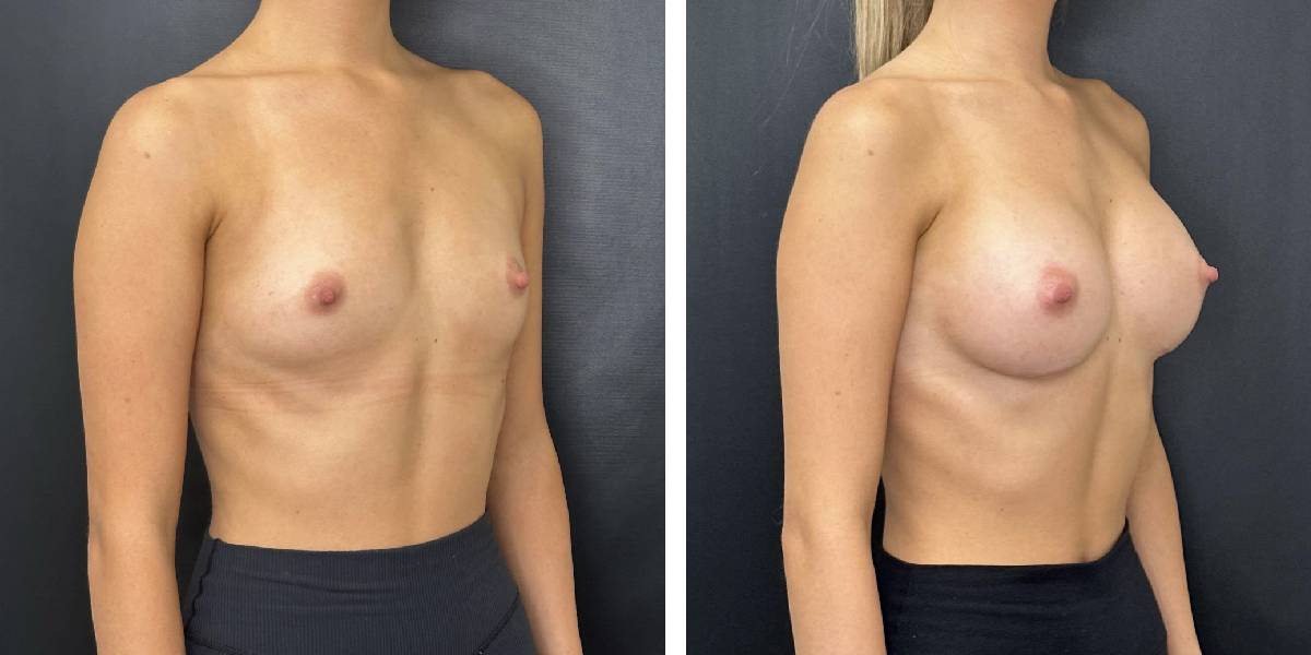 before and after breast augmentation female patient right angled view case 2025