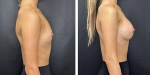 before and after breast augmentation female patient right side view case 2025