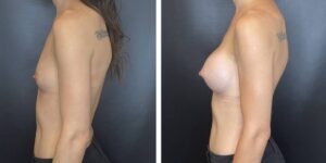 before and after breast augmentation female patient left side view case 2032