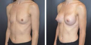 before and after breast augmentation female patient left angled view case 2032