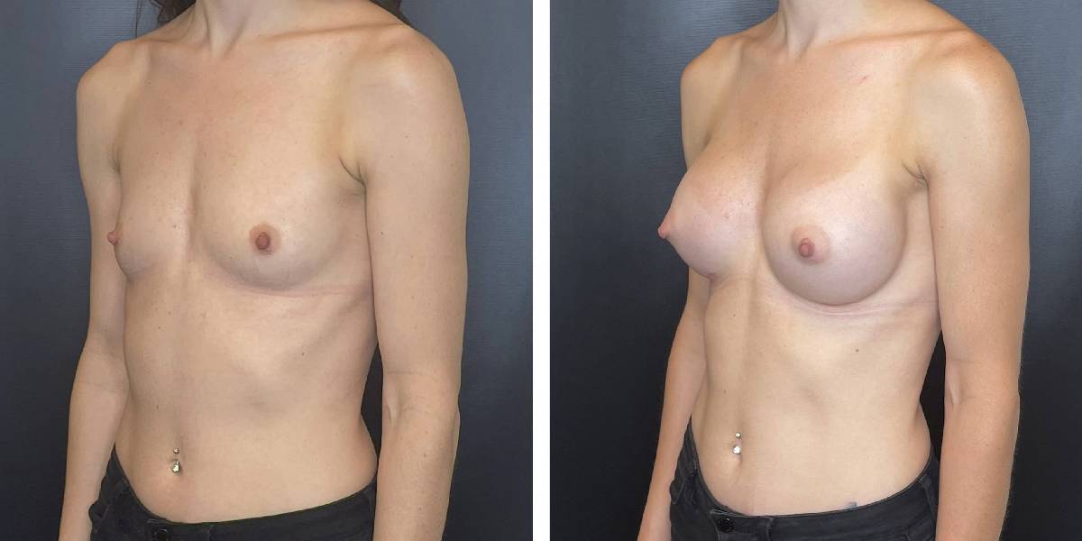 before and after breast augmentation female patient left angled view case 2032