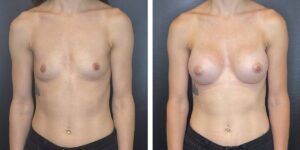 before and after breast augmentation female patient front view case 2032