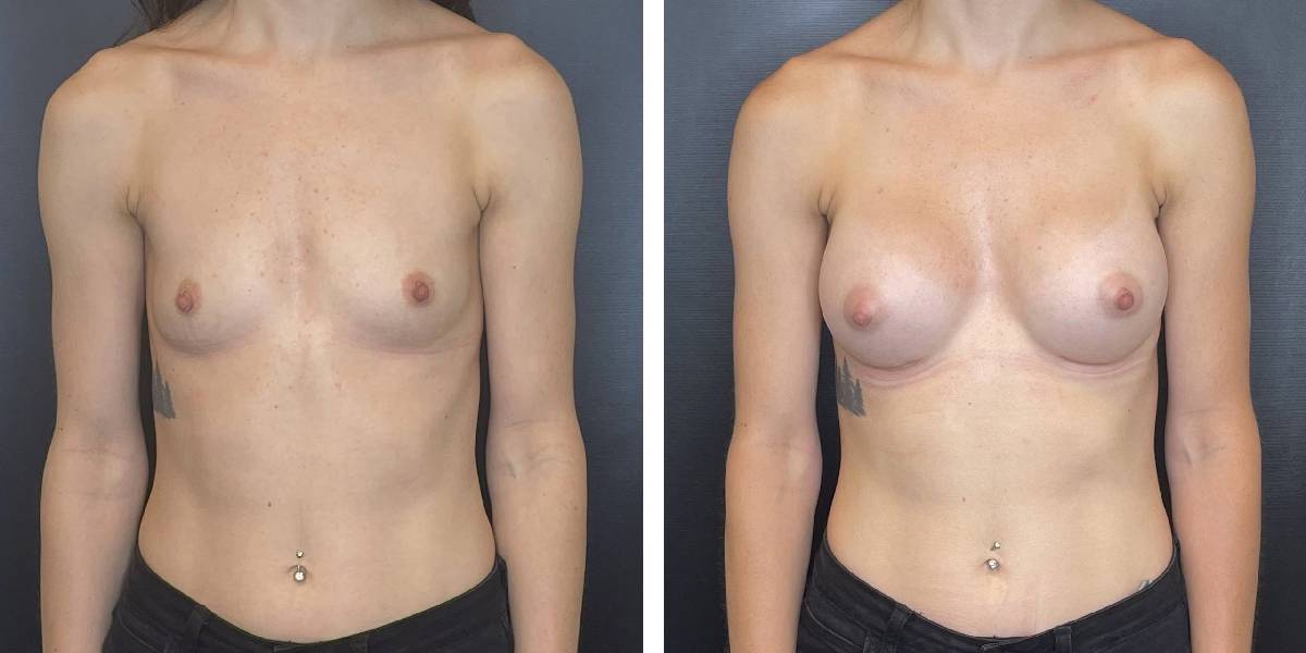 before and after breast augmentation female patient front view case 2032
