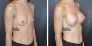 before and after breast augmentation female patient right angled view case 2032