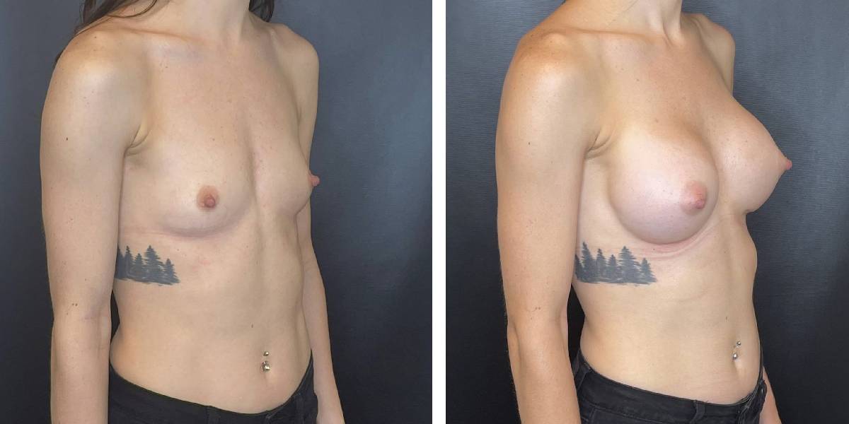 before and after breast augmentation female patient right angled view case 2032