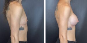 before and after breast augmentation female patient right side view case 2032