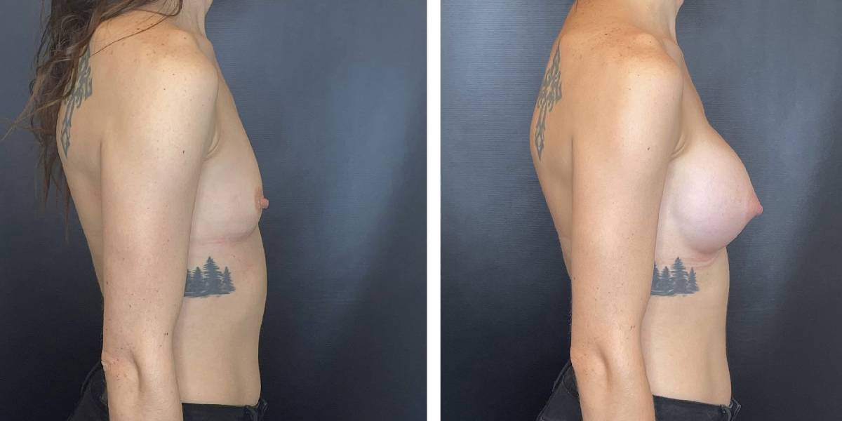 before and after breast augmentation female patient right side view case 2032
