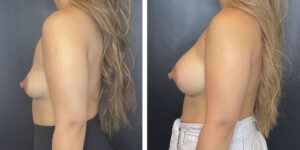 before and after breast augmentation female patient left side view case 2038