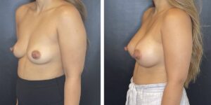 before and after breast augmentation female patient left angled view case 2038