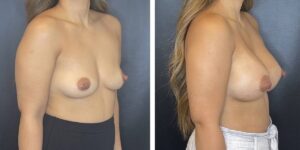 before and after breast augmentation female patient right angled view case 2038