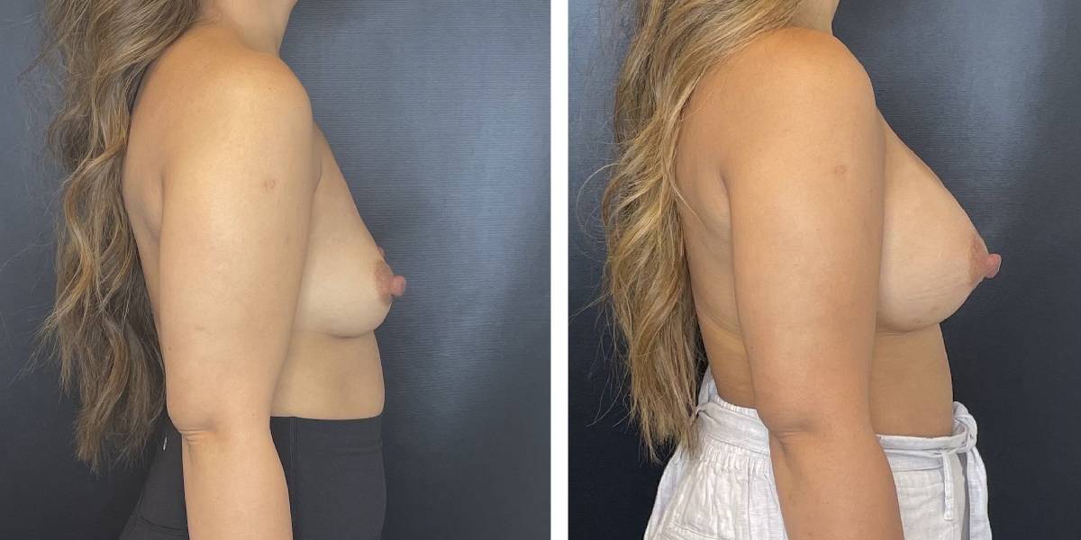 before and after breast augmentation female patient right side view case 2038