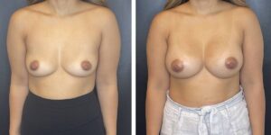 before and after breast augmentation female patient front view case 2038