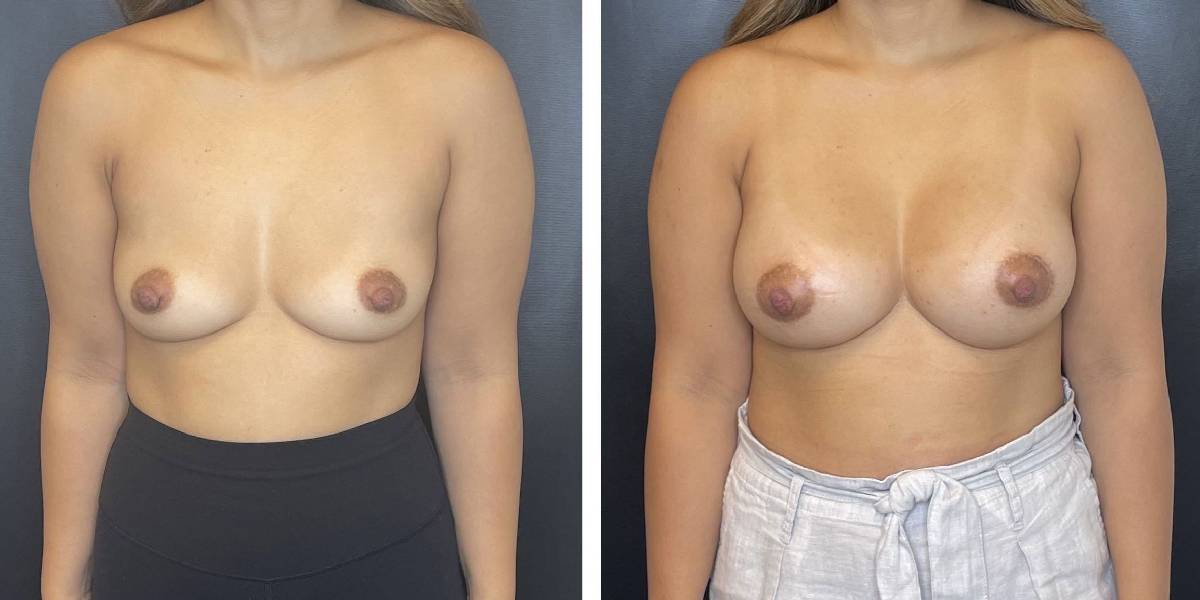before and after breast augmentation female patient front view case 2038
