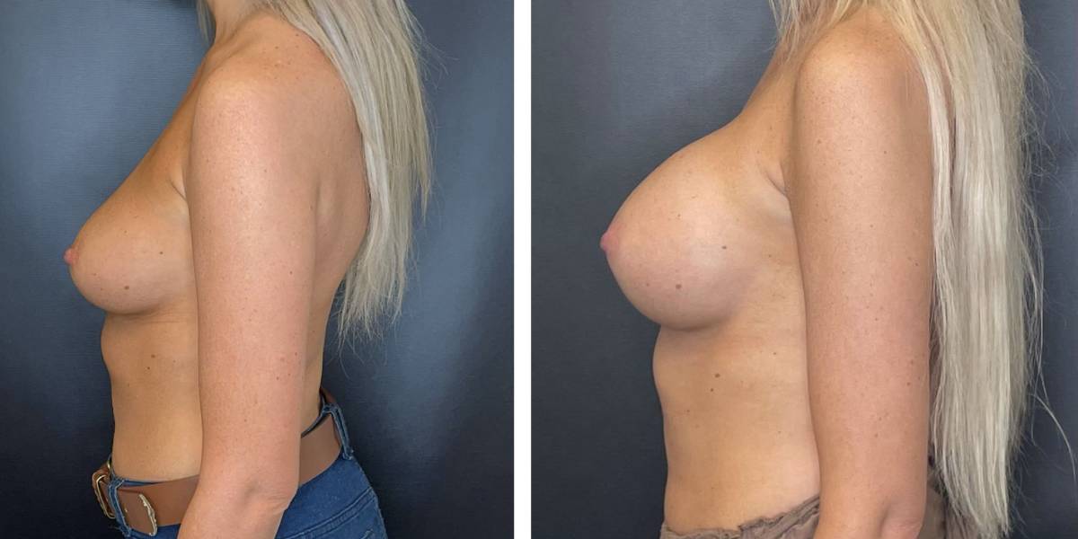 before and after breast augmentation female patient left side view case 2049