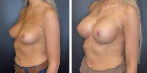 before and after breast augmentation female patient left angled view case 2049