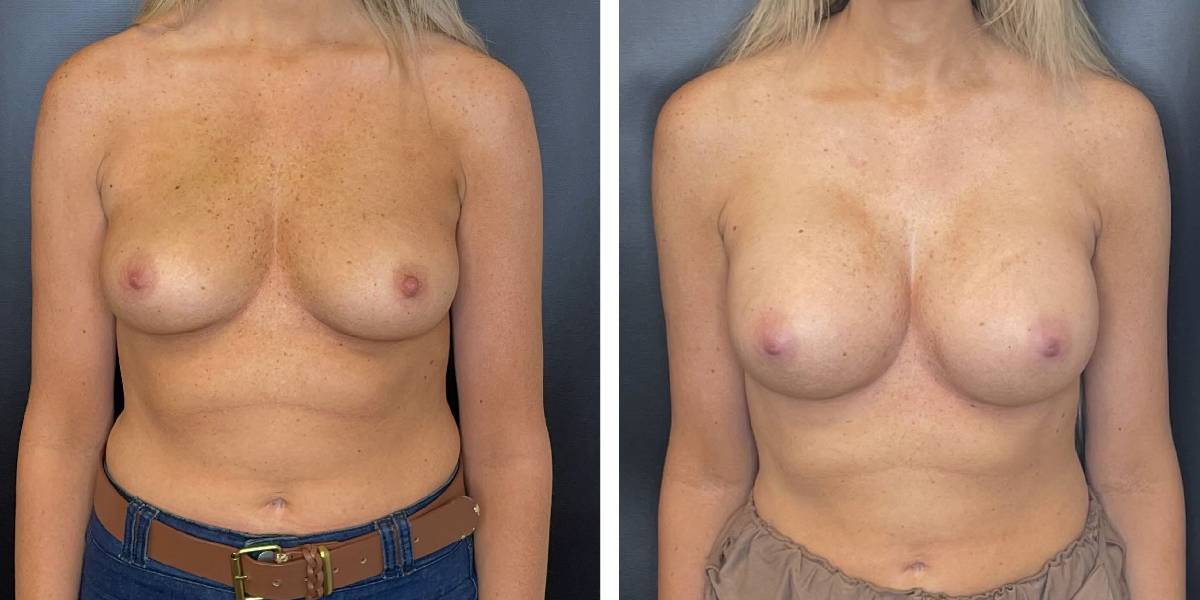 before and after breast augmentation female patient front view case 2049