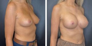 before and after breast augmentation female patient right angled view case 2049