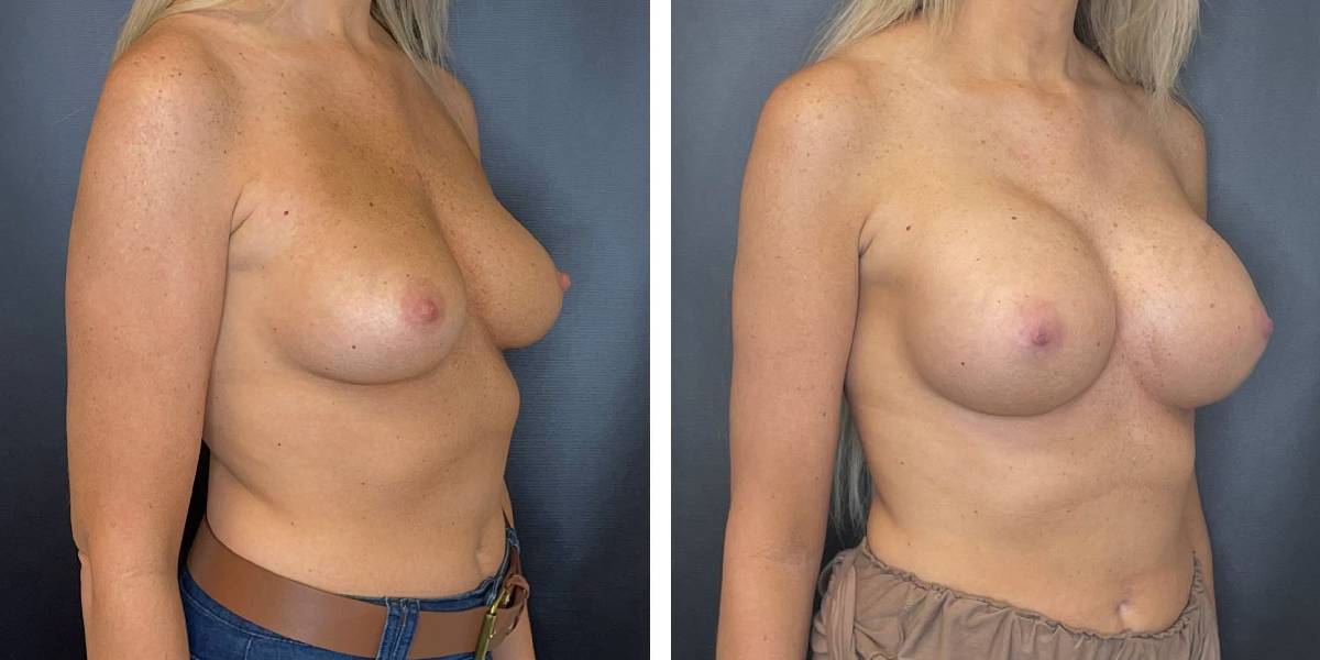 before and after breast augmentation female patient right angled view case 2049