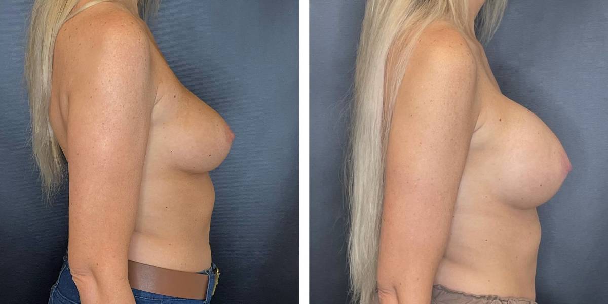 before and after breast augmentation female patient right side view case 2049