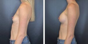 before and after breast augmentation female patient left side view case 2058