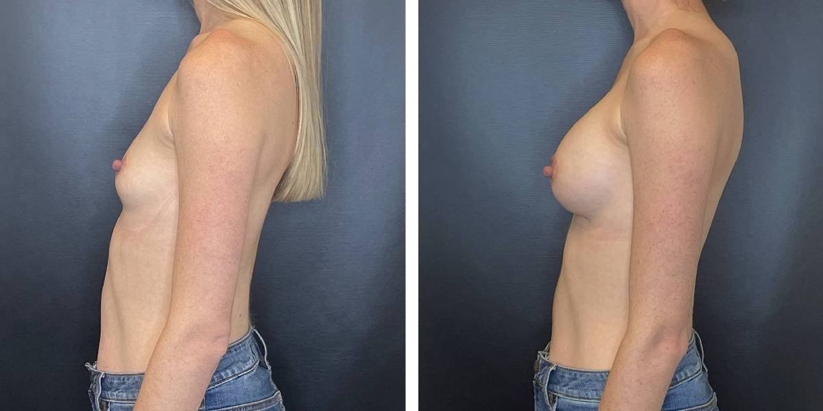 before and after breast augmentation female patient left side view case 2058