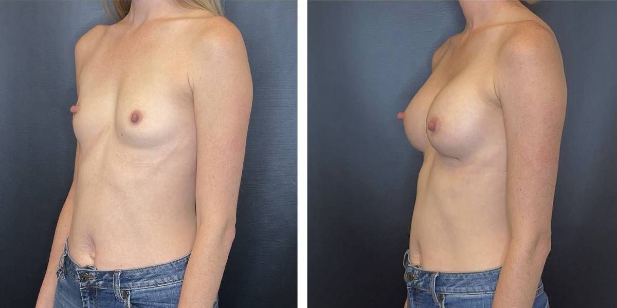 before and after breast augmentation female patient left angled view case 2058