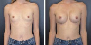 before and after breast augmentation female patient front view case 2058