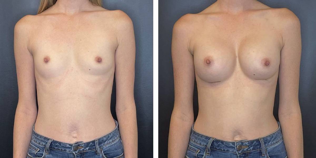 before and after breast augmentation female patient front view case 2058