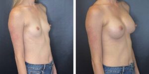 before and after breast augmentation female patient right angled view case 2058
