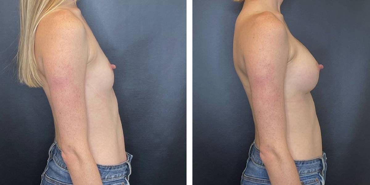 before and after breast augmentation female patient right side view case 2058