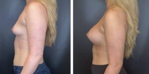 before and after breast augmentation female patient left side view case 2064