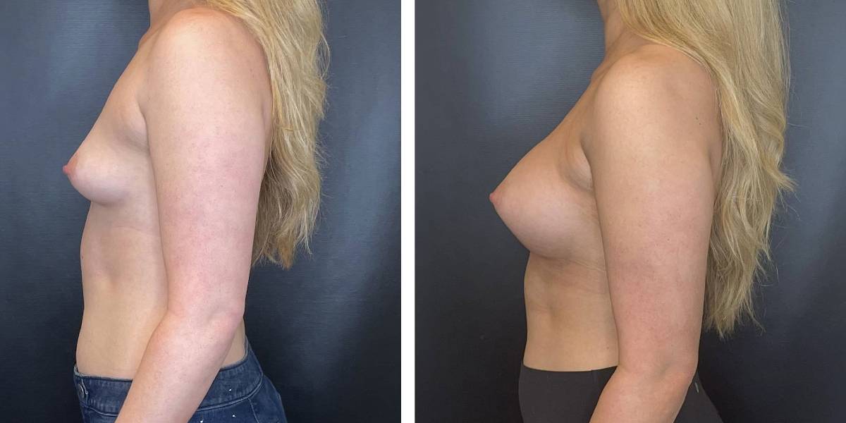 before and after breast augmentation female patient left side view case 2064