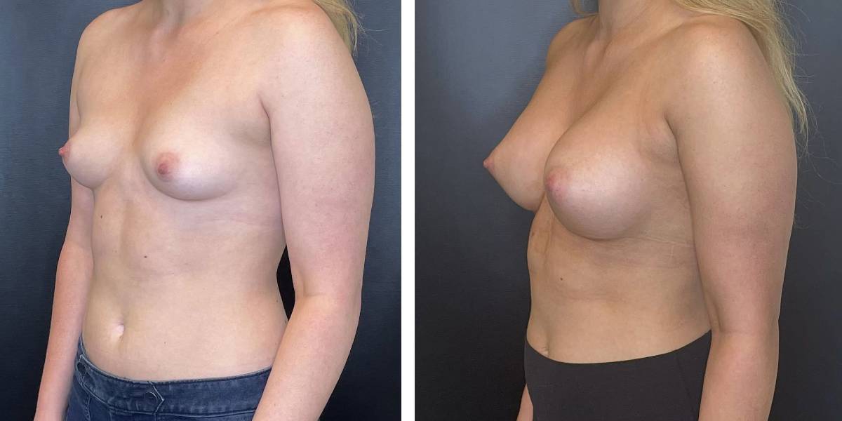 before and after breast augmentation female patient left angled view case 2064