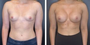 before and after breast augmentation female patient front view case 2064