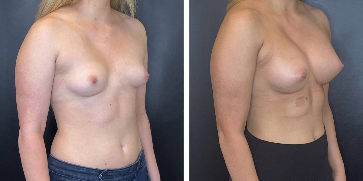 before and after breast augmentation female patient right angled view case 2064