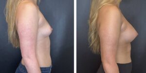 before and after breast augmentation female patient right side view case 2064