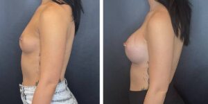 before and after breast augmentation female patient left side view case 2070
