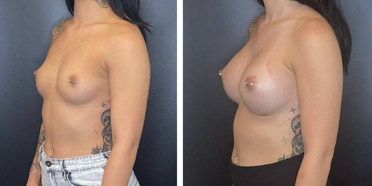 before and after breast augmentation female patient left angled view case 2070