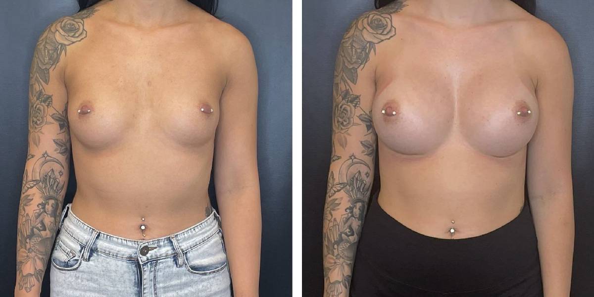 before and after breast augmentation female patient front view case 2070